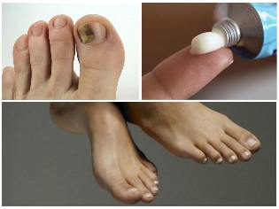 nail fungus on the feet, ointment