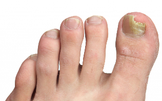 nail fungus on the feet of the stage