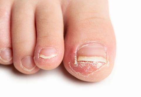 what does nail fungus look like