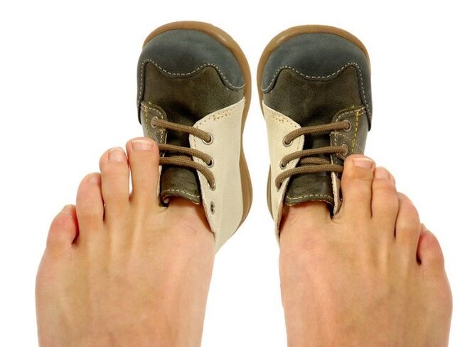 tight shoes as the cause of fungus between the toes