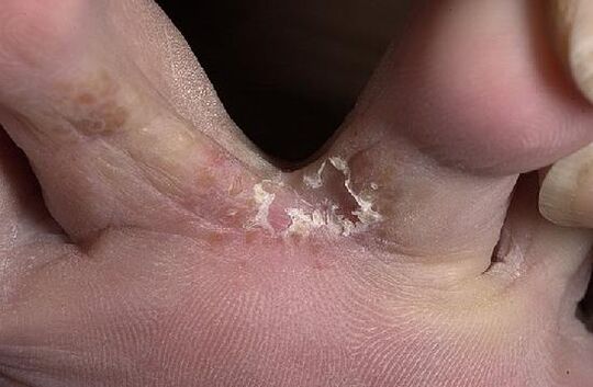 toes affected by a fungus