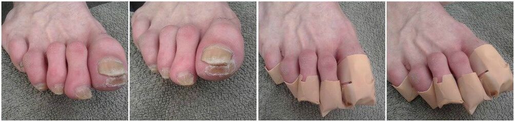 Apply patches for nail fungus