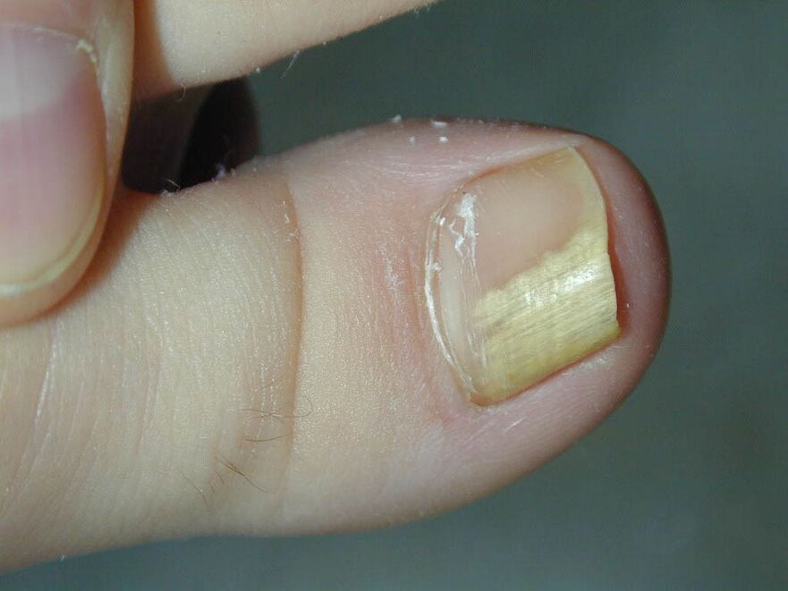 Symptom of fungus - discoloration of the nail