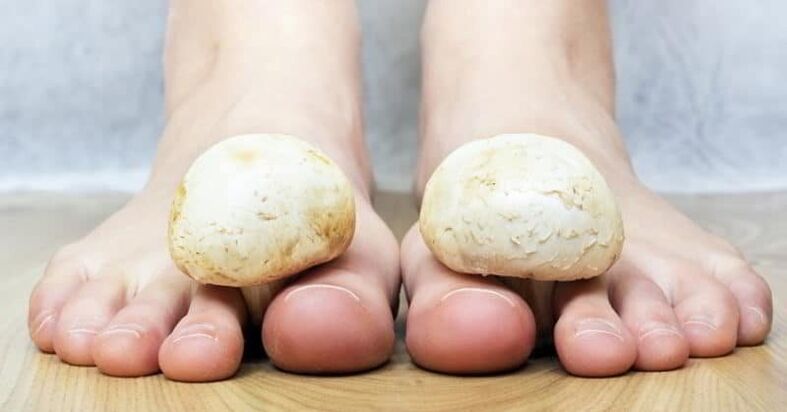fungus on the skin of the feet