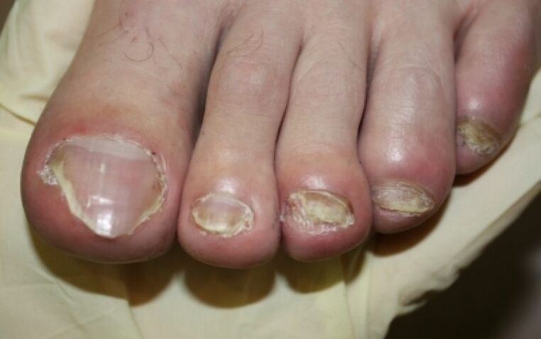 Nail mushroom