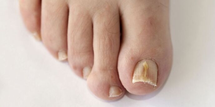 Nail mushroom