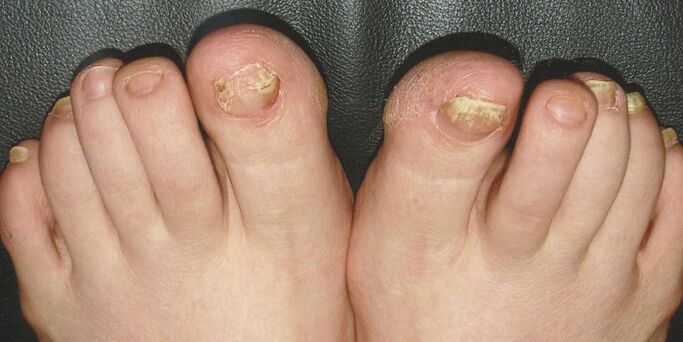 Onychomycosis nails on the legs