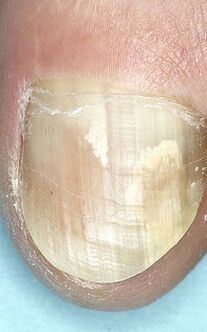 Nail mushroom