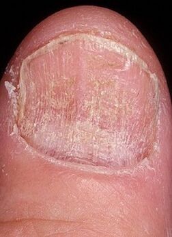 Nail yeast