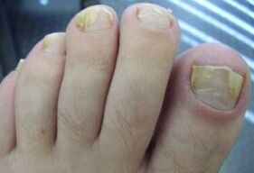 Assigned by the nail with fungal infections