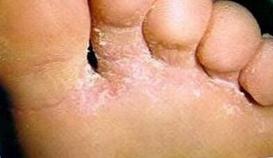 How to recognize the fungus on the fingers