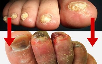 Mushroom manifestations on the fingers
