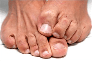itchy skin on the feet due to fungal nail infection