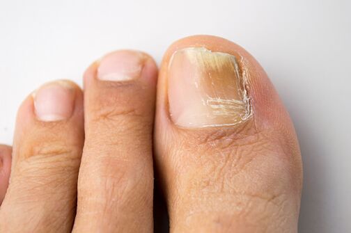 nail fungus