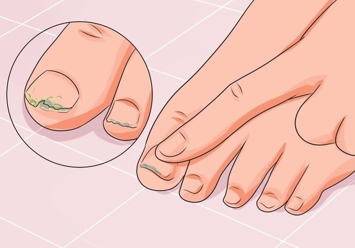 how to treat nail fungus with drops