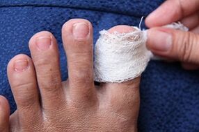 compress for nail fungus