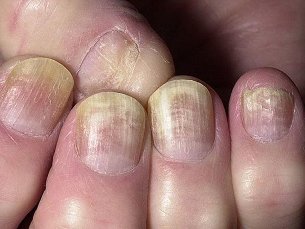 fungus on nails