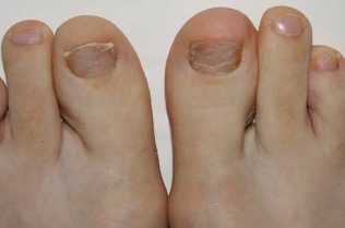 Symptoms of fungus on your feet
