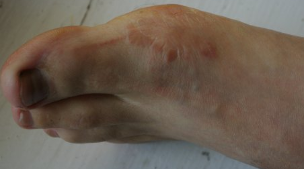 fungus on the feet, is in the initial stage,
